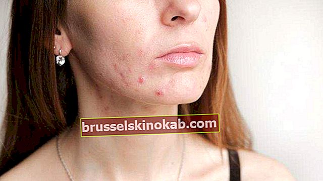 Folikulitida: naučte se, jak léčit tuto kožní infekci